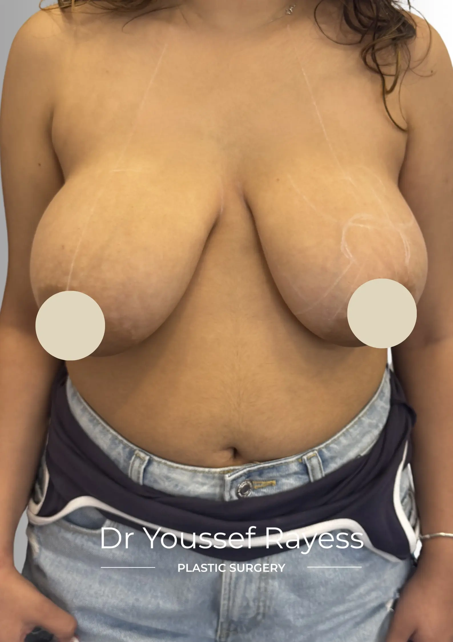 Front view before breast reduction surgery by Dr Youssef Rayess in Beirut