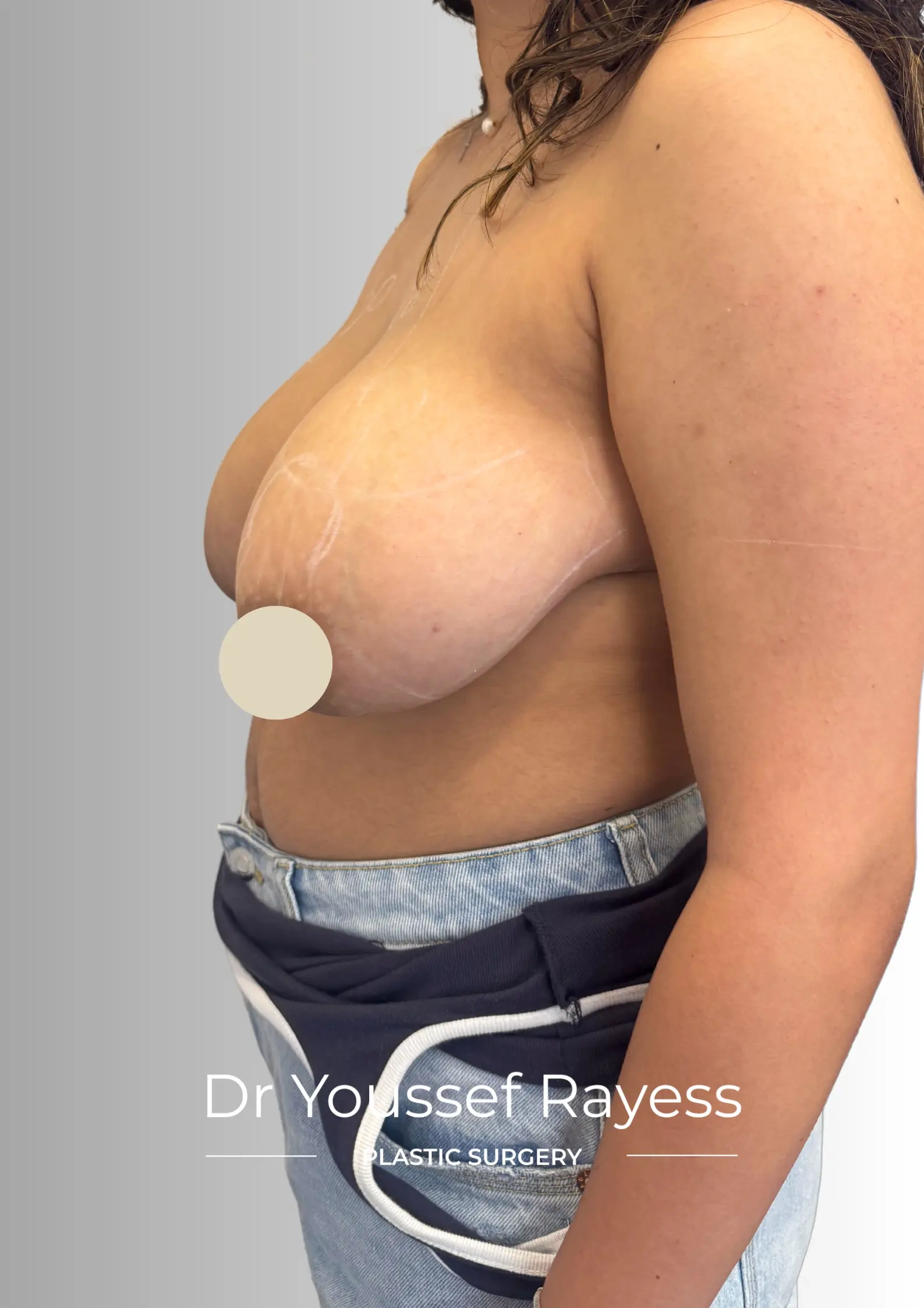 Left side view before breast reduction surgery by Dr Youssef Rayess in Beirut