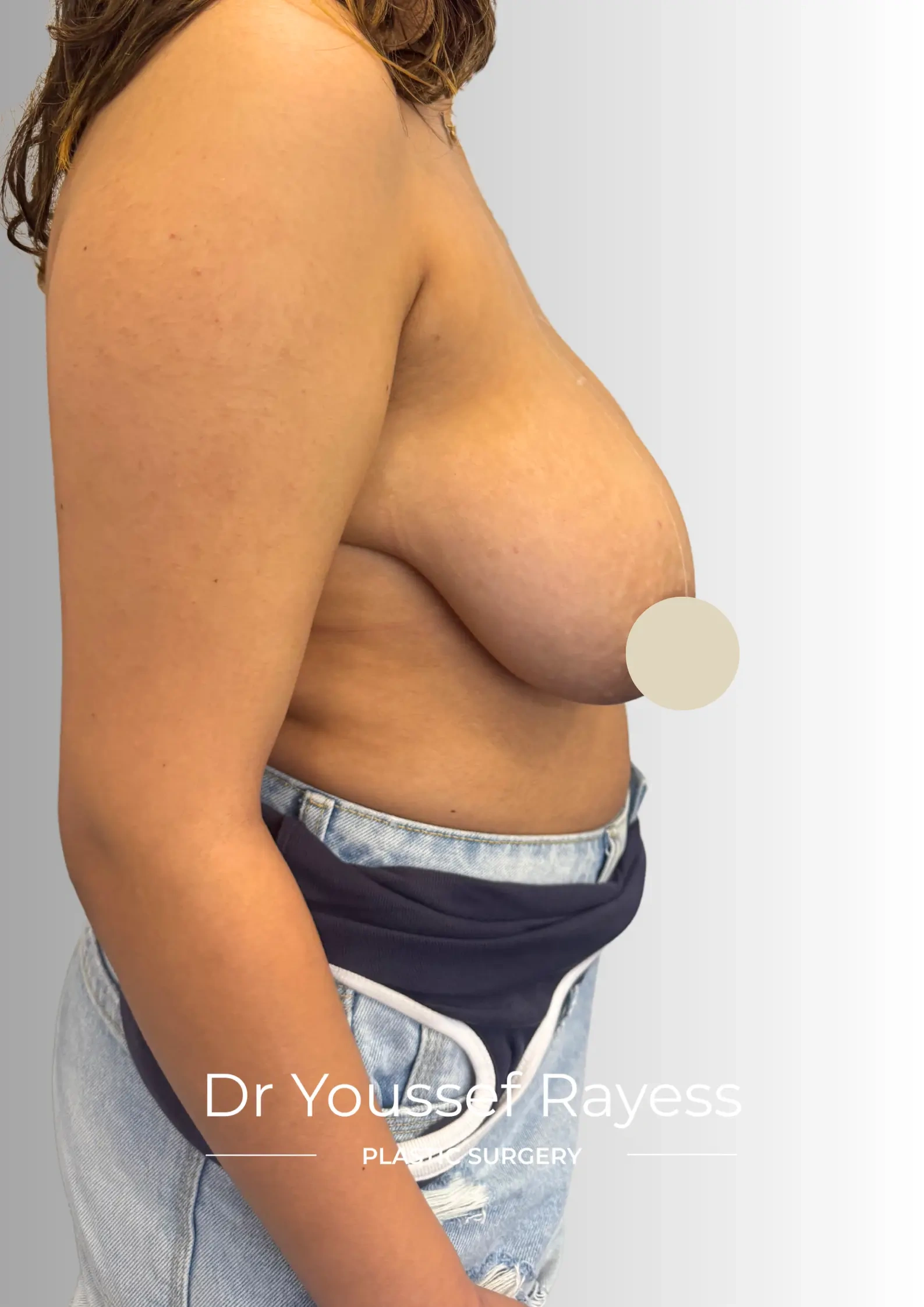 Right side view before breast reduction surgery by Dr Youssef Rayess in Beirut