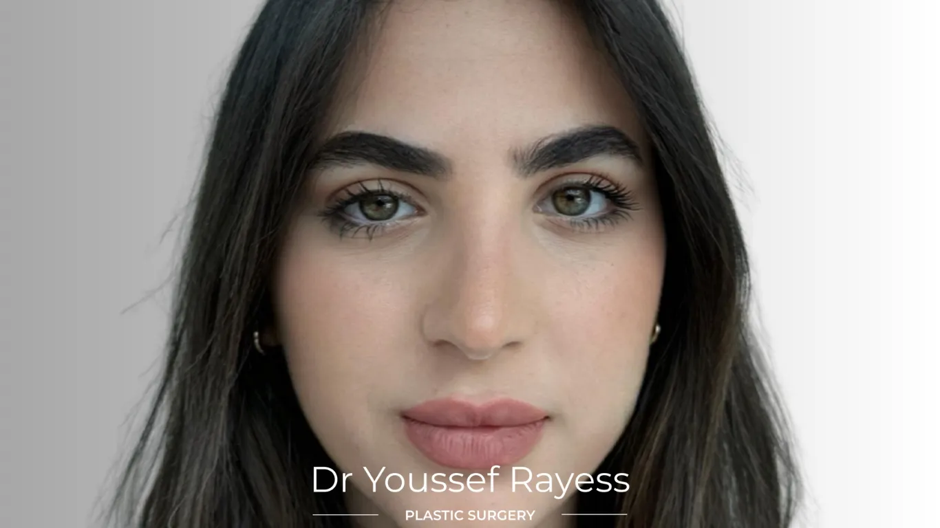 Front view after structural rhinoplasty result by Dr Youssef Rayess in Beirut and Dubai showing natural nasal refinement and facial harmony