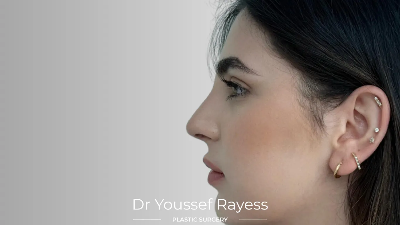 Left side view after structural rhinoplasty result by Dr Youssef Rayess in Beirut and Dubai showing natural nasal refinement and facial harmony