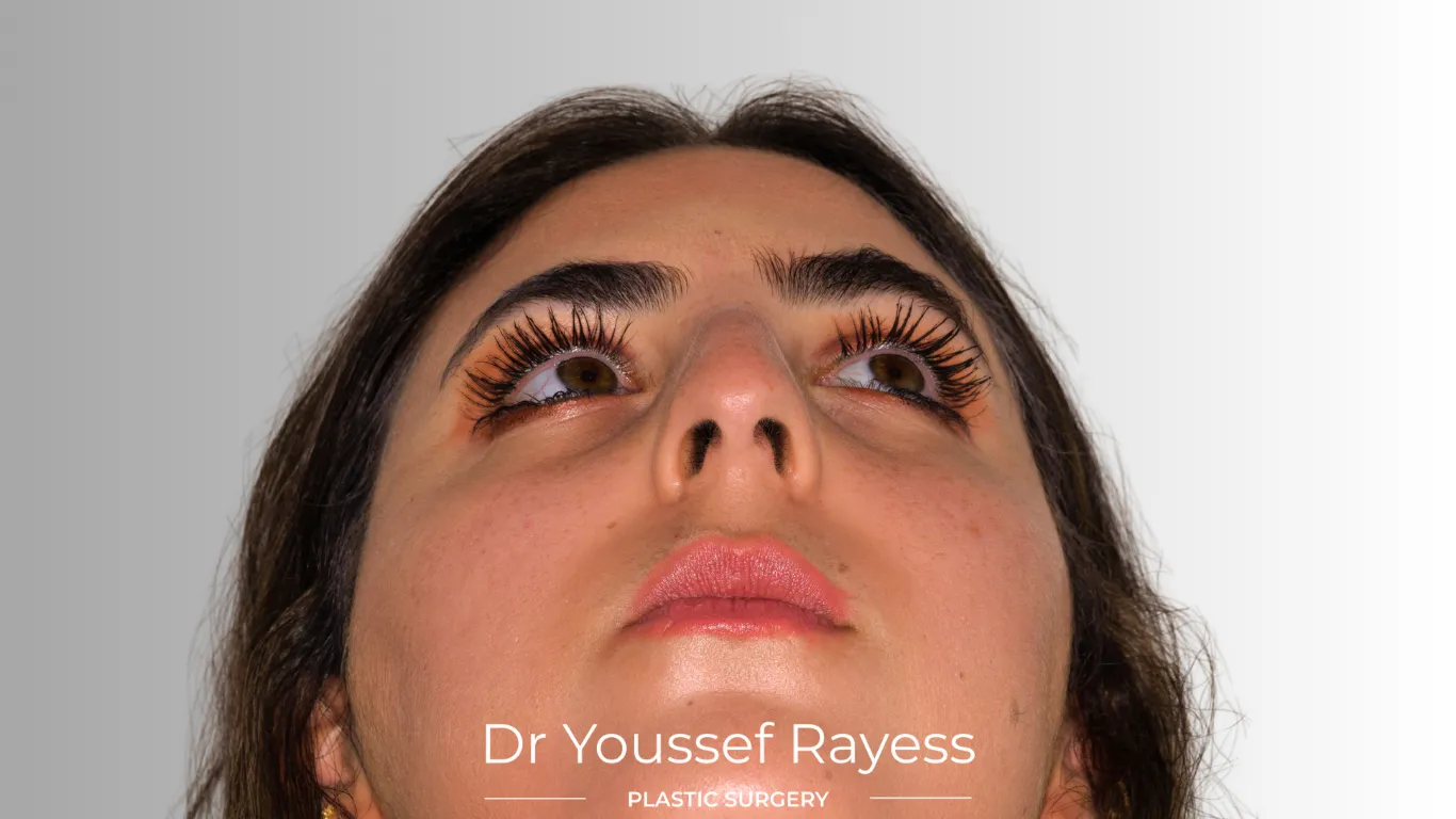 Basal view before structural rhinoplasty by Dr Youssef Rayess in Beirut and Dubai