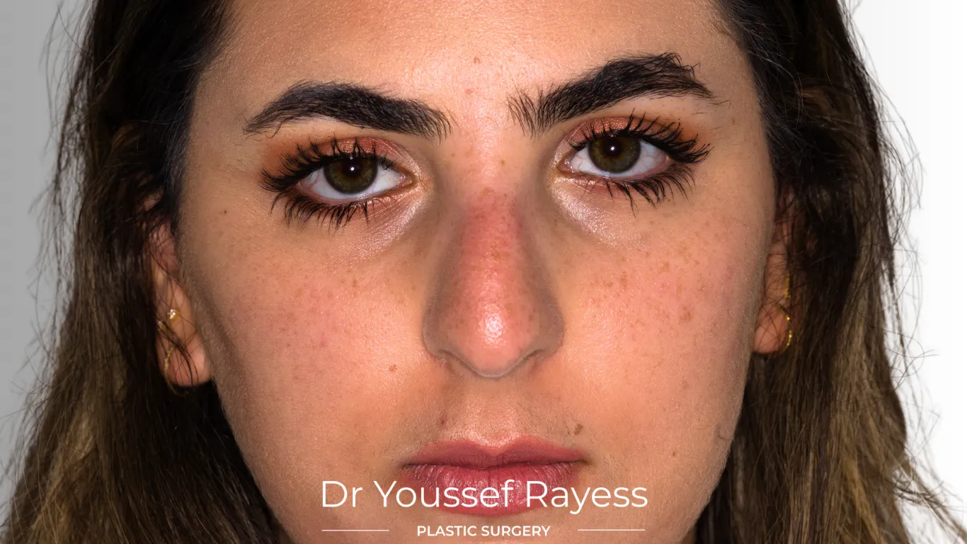 Front view before structural rhinoplasty by Dr Youssef Rayess in Beirut and Dubai
