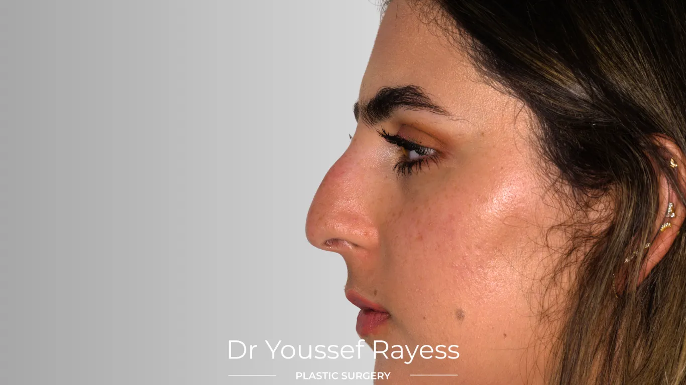 Left side view before structural rhinoplasty by Dr Youssef Rayess in Beirut and Dubai